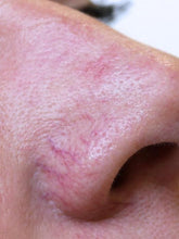 Load image into Gallery viewer, BF Acutip -Nose Veins- 1 session
